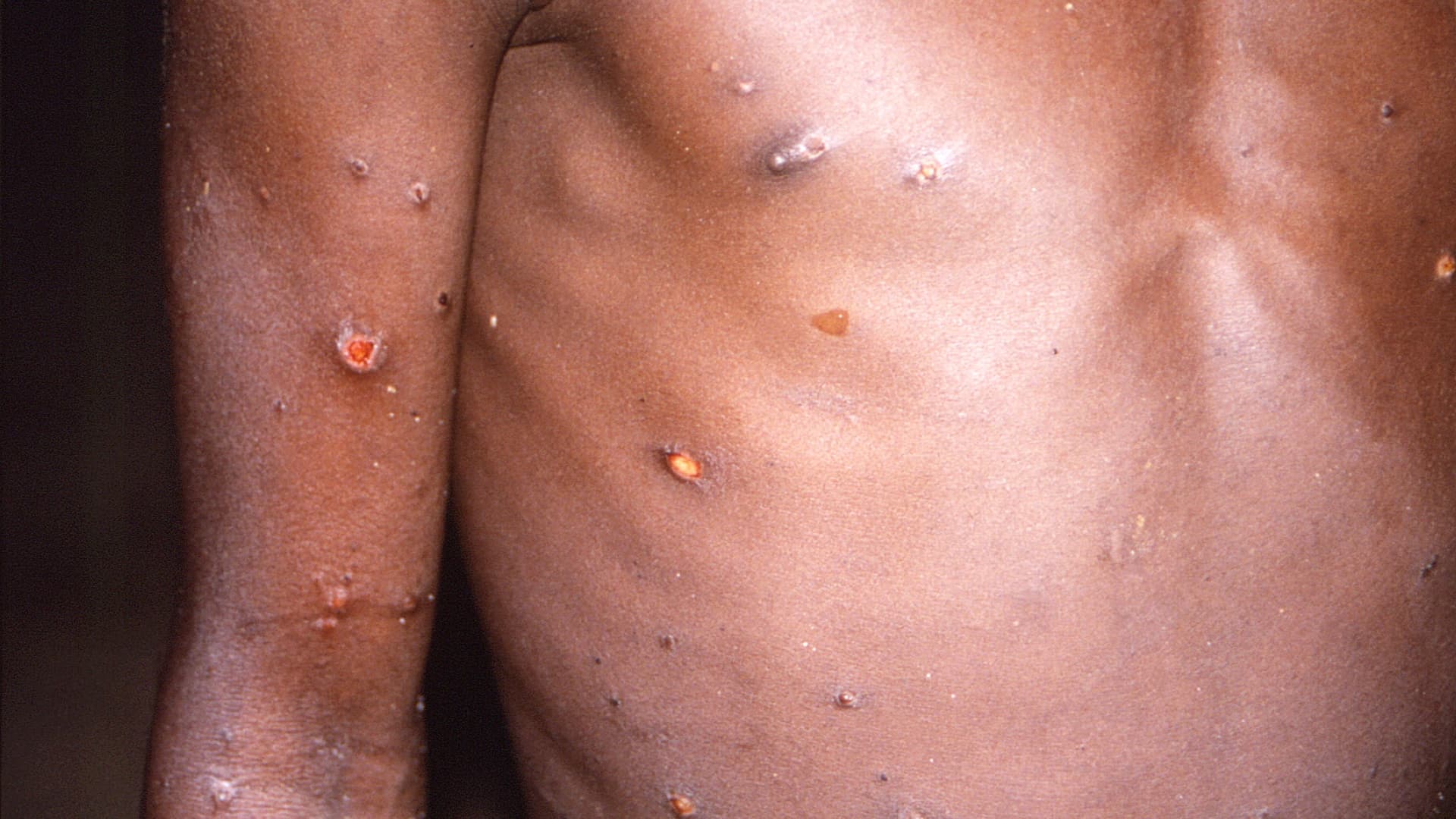 New York City resident tests positive for monkeypox virus